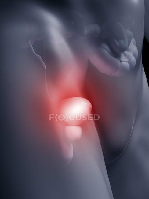 Illustration of inflamed human bladder in body silhouette. — Stock Photo