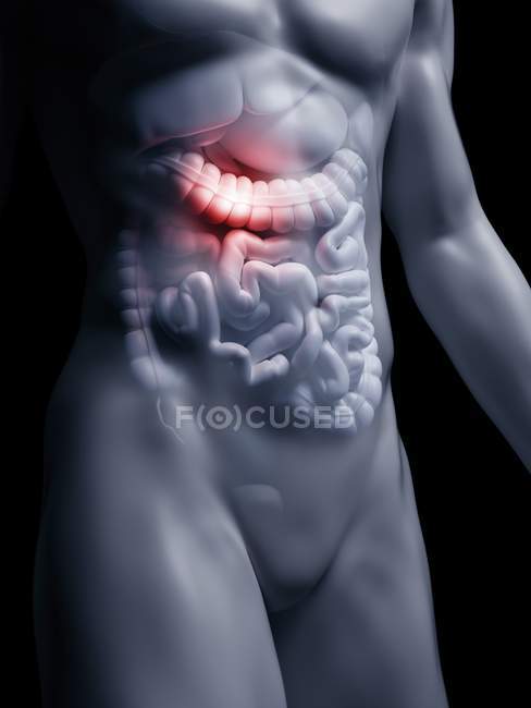 Ilustración del intestino grueso inflamado humano en la silueta corporal
. - foto de stock