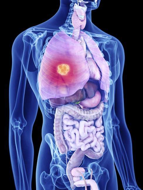 Иллюстрация рака легких в силуэте человеческого тела
. — стоковое фото