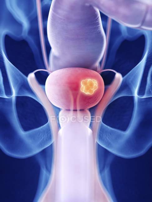 Illustration of bladder cancer in human body silhouette. — Stock Photo