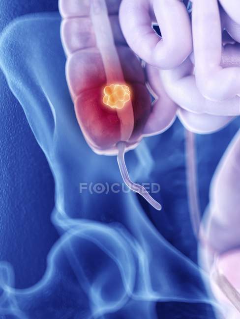 Ilustración del cáncer de colon en la silueta del cuerpo humano . - foto de stock