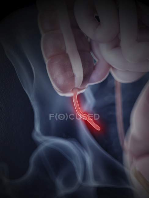 Медичні ілюстрація запалені додатку в організмі людини. — стокове фото