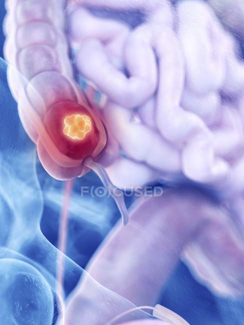 Ilustração do câncer de cólon na silhueta do corpo humano . — Fotografia de Stock