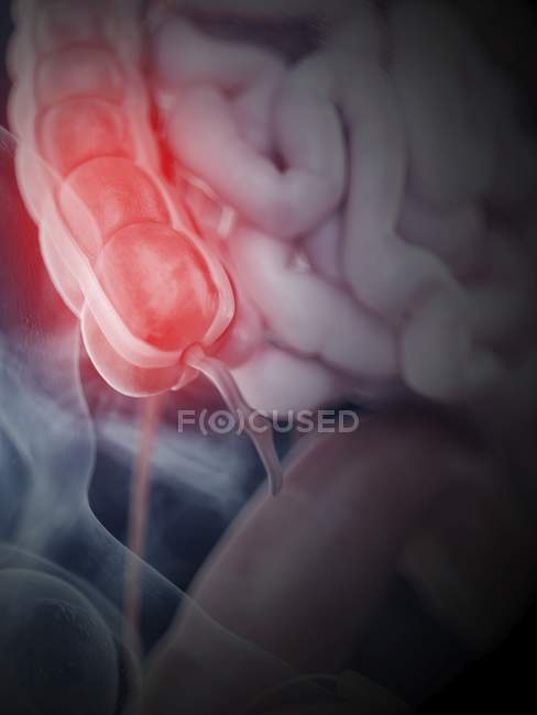 Ilustración de colon inflamado en el cuerpo humano . - foto de stock
