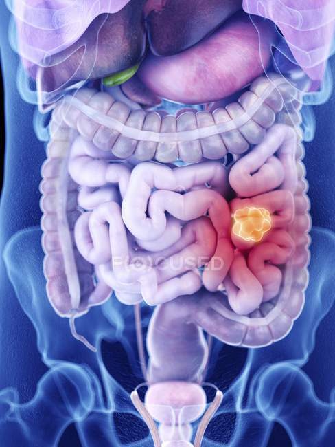 Ilustración del cáncer de intestino en la silueta del cuerpo humano
. - foto de stock