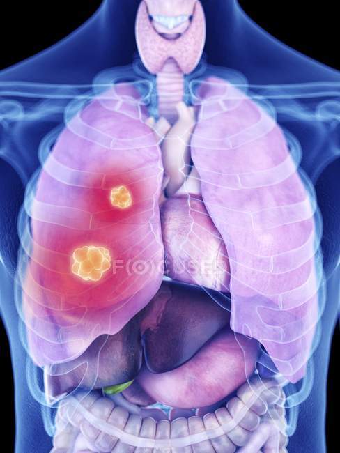 Ilustração do câncer de pulmão na silhueta do corpo humano . — Fotografia de Stock