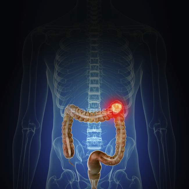 Illustration du cancer du côlon dans la silhouette du corps humain
. — Photo de stock