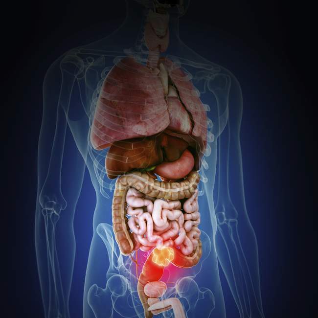Ilustración del cáncer de colon en la silueta del cuerpo humano
. - foto de stock