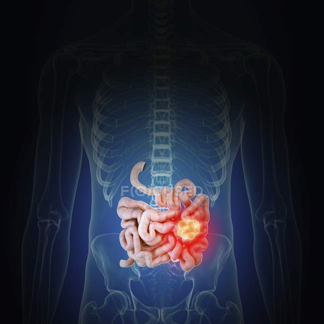 Ilustración del cáncer de intestino en la silueta del cuerpo humano . - foto de stock