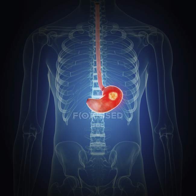 Illustration du cancer de l'estomac dans la silhouette du corps humain
. — Photo de stock