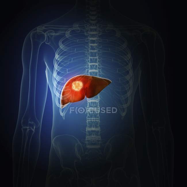 Ilustración del cáncer de hígado en la silueta del cuerpo humano
. - foto de stock