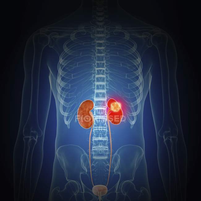 Ілюстрація раку нирки у організму людини силует. — стокове фото