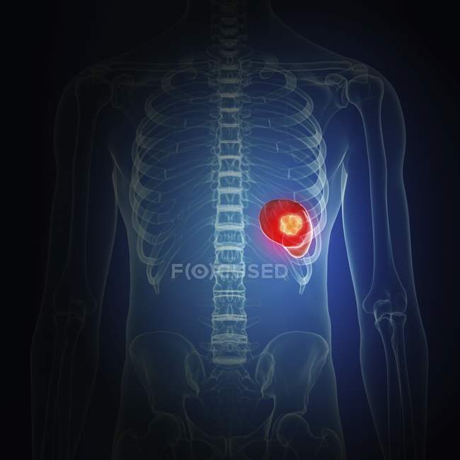 Illustration of spleen cancer in human body silhouette. — Stock Photo