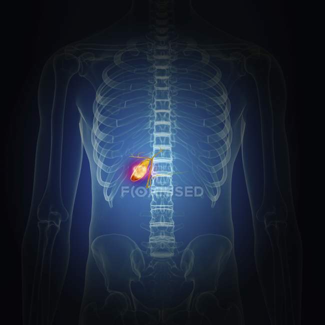 Illustrazione del cancro della cistifellea nella silhouette del corpo umano . — Foto stock