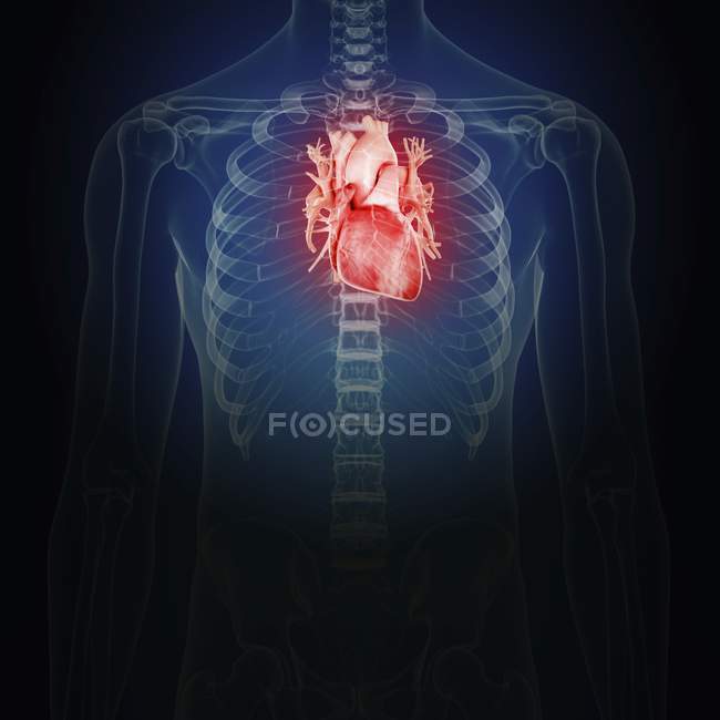 Иллюстрация воспалённого сердца в силуэте человеческого тела . — стоковое фото