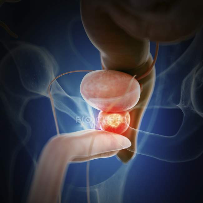 Illustration du cancer de la prostate dans la silhouette du corps humain
. — Photo de stock