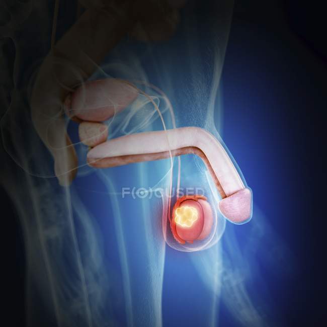 Illustration of testicle cancer in human body silhouette. — Stock Photo
