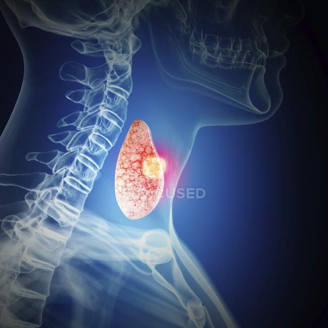 Ilustración del cáncer de tiroides en la silueta de la garganta humana
. - foto de stock