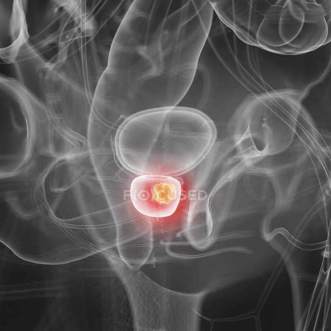 Ilustración del cáncer de próstata en la silueta del cuerpo humano
. - foto de stock