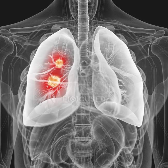 Illustration du cancer du poumon dans la silhouette du corps humain . — Photo de stock