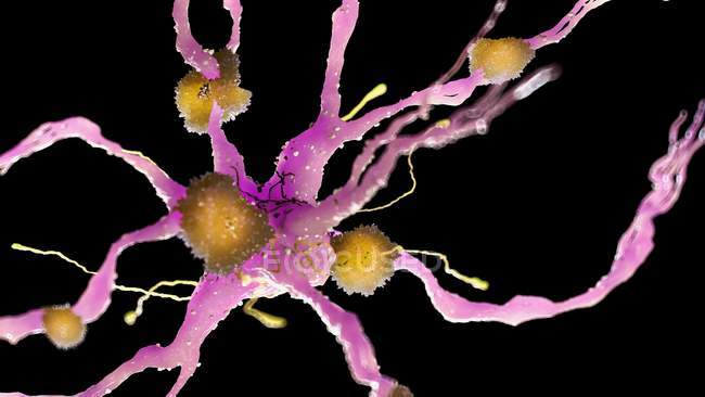 Illustrazione a colori delle placche amiloidi sulle cellule nervose . — Foto stock