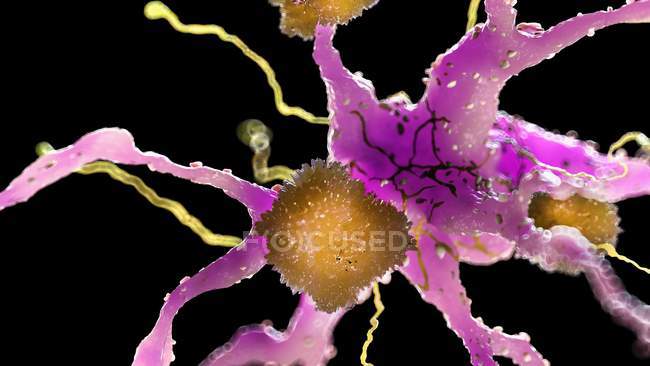 Ilustración coloreada de placas amiloides en células nerviosas . - foto de stock