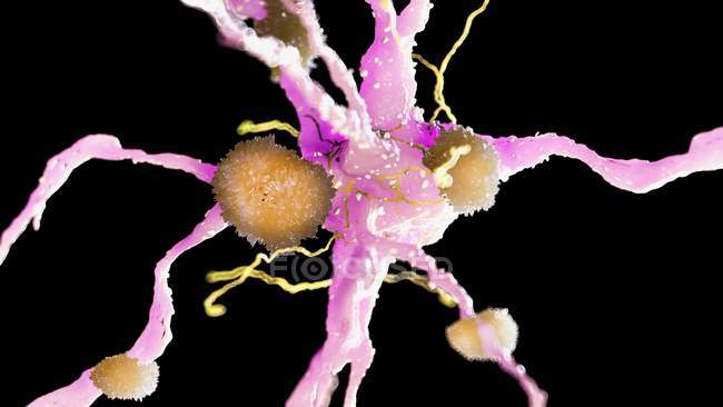 Farbige Darstellung von Amyloid-Plaques auf Nervenzellen. — Stockfoto