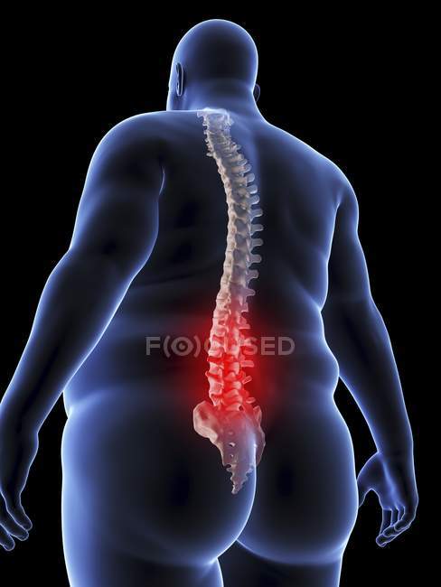 Ілюстрація силуету ожиріння людини з болем у спині . — стокове фото
