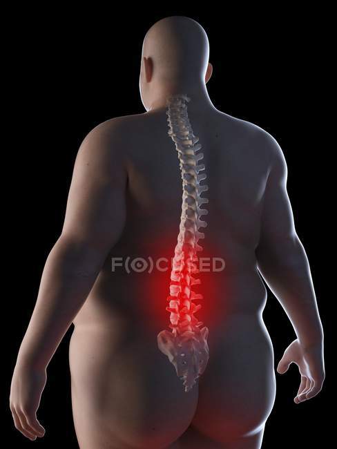 Illustration der Silhouette eines fettleibigen Mannes mit Rückenschmerzen. — Stockfoto