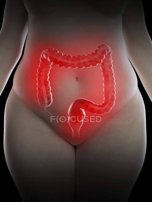 Illustration einer übergewichtigen Frau mit entzündetem Doppelpunkt auf schwarzem Hintergrund. — Stockfoto