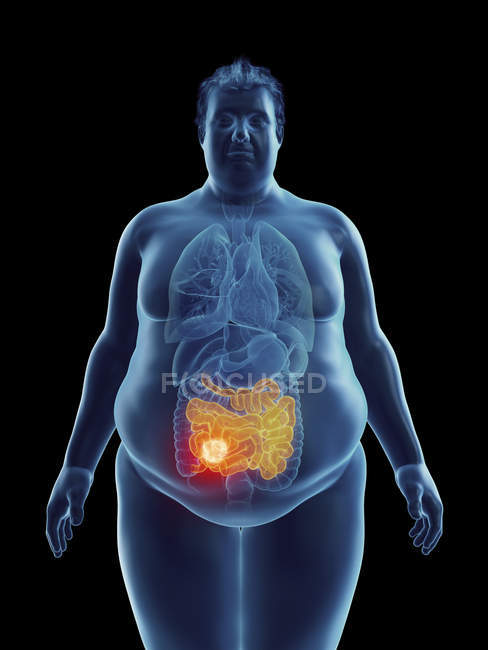 Ilustración de la silueta del hombre obeso con tumor intestinal resaltado . - foto de stock