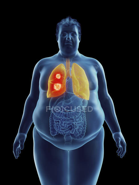 Ilustración de la silueta del hombre obeso con tumor pulmonar resaltado
. - foto de stock