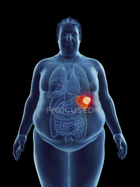 Ілюстрація силует ожирінням людина з виділених селезінки пухлини. — стокове фото