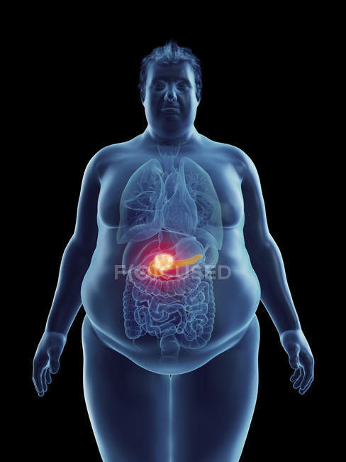 Ilustración de la silueta del hombre obeso con tumor de páncreas resaltado . - foto de stock