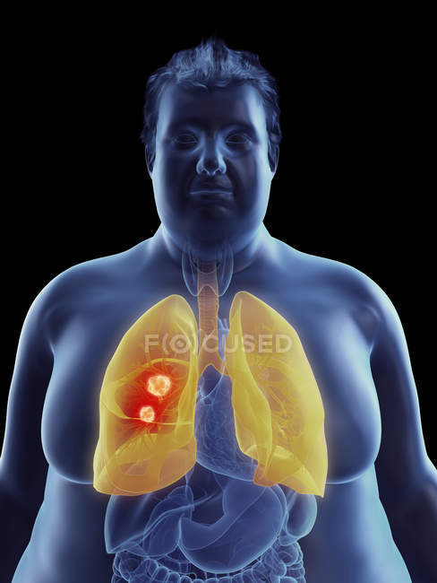 Ilustración de la silueta del hombre obeso con tumor pulmonar resaltado
. - foto de stock