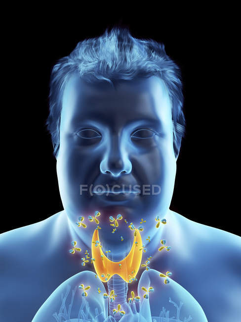 Illustration of autoimmune thyroid disease in obese man body. — Stock Photo