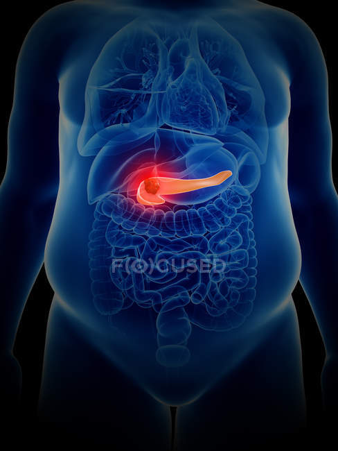 Illustrazione del cancro al pancreas nella silhouette del corpo umano . — Foto stock