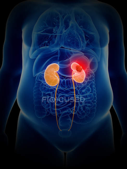Ilustração do câncer renal na silhueta do corpo humano
. — Fotografia de Stock