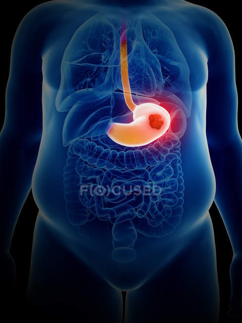 Illustration du cancer de l'estomac dans la silhouette du corps humain
. — Photo de stock