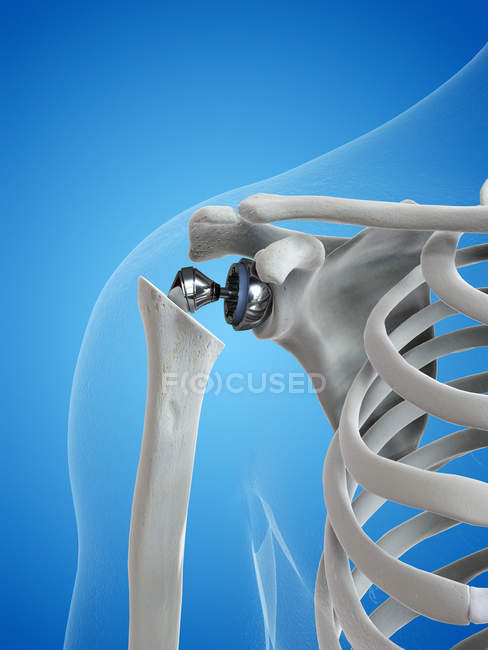 Illustration of shoulder replacement in human skeleton. — Stock Photo