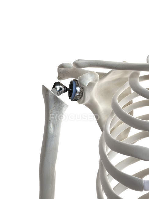 Ilustración del reemplazo de hombro en el esqueleto humano . - foto de stock
