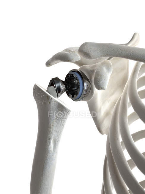 Illustration des Schulterersatzes im menschlichen Skelett. — Stockfoto