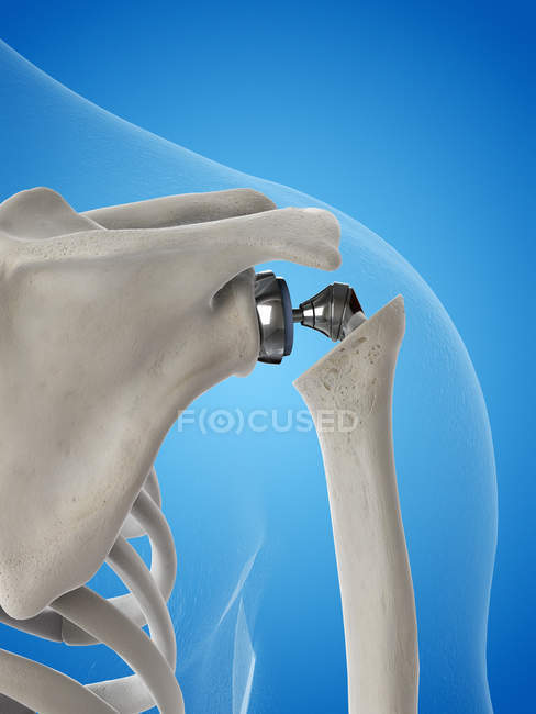 Ilustración del reemplazo de hombro en el esqueleto humano . - foto de stock