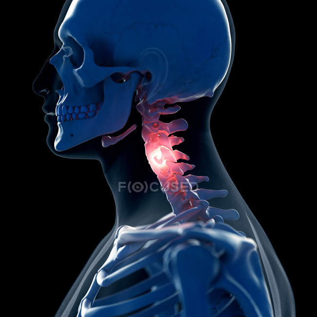 Цифрова ілюстрація болючої шиї в людському скелеті . — стокове фото