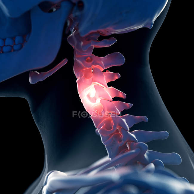 Ilustración digital del cuello doloroso en el esqueleto humano . - foto de stock
