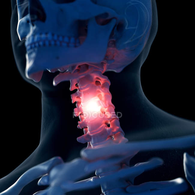Цифрова ілюстрація болючої шиї в людському скелеті . — стокове фото