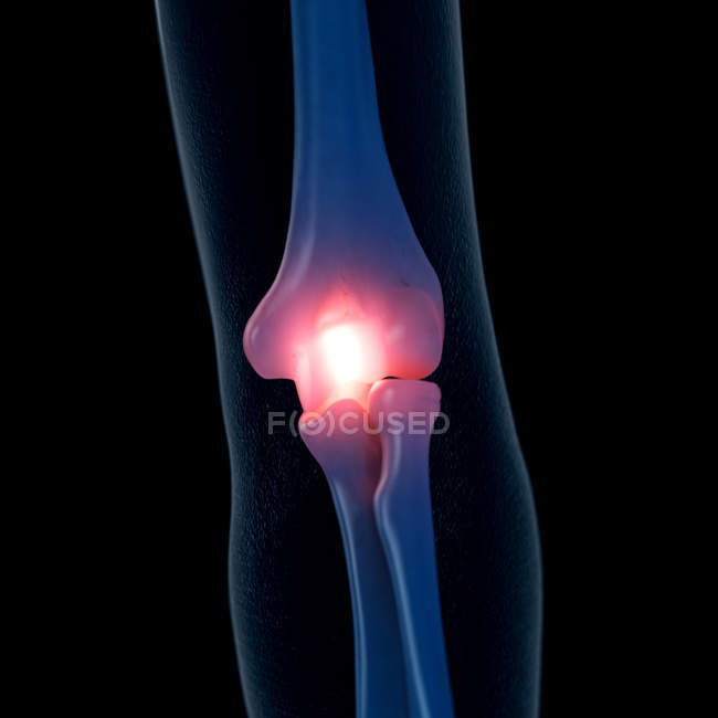 Digital illustration of painful elbow in human skeleton. — Stock Photo