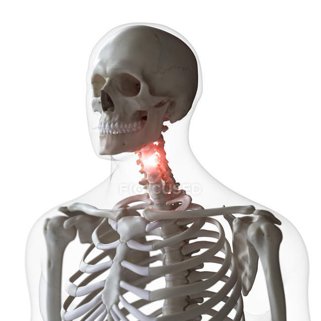 Цифрова ілюстрація болючого шийного хребта в людському скелеті . — стокове фото