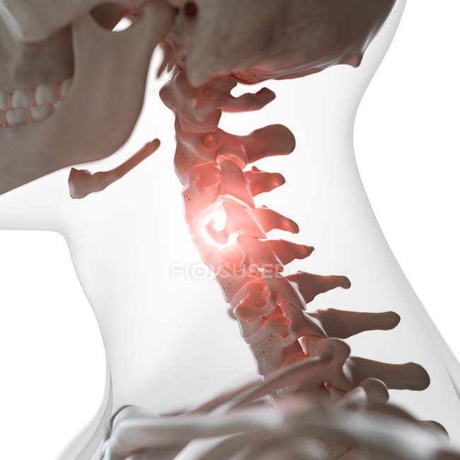Illustration numérique de la colonne cervicale douloureuse dans le squelette humain . — Photo de stock