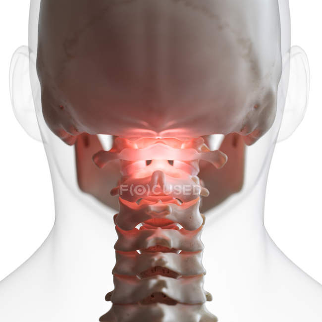 Digital illustration of painful atlas bone in human skeleton. — Stock Photo